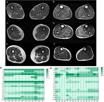 Skeletal Muscle Involvement Pattern of Hereditary Transthyretin Amyloidosis: A Study Based on Muscle MRI